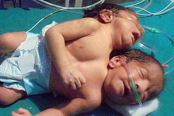 У индийских мальчиков-близнецов одно тело на двоих