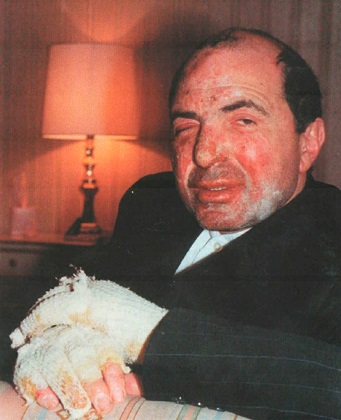 Березовский после покушения в 1994 году