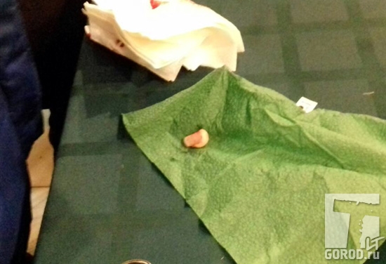 Отрубленная фаланга пальца на салфетке в кафе