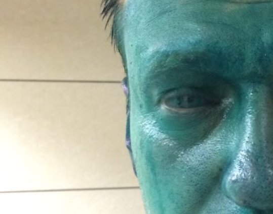 Навальному зеленкой повредили зрачок и роговицу